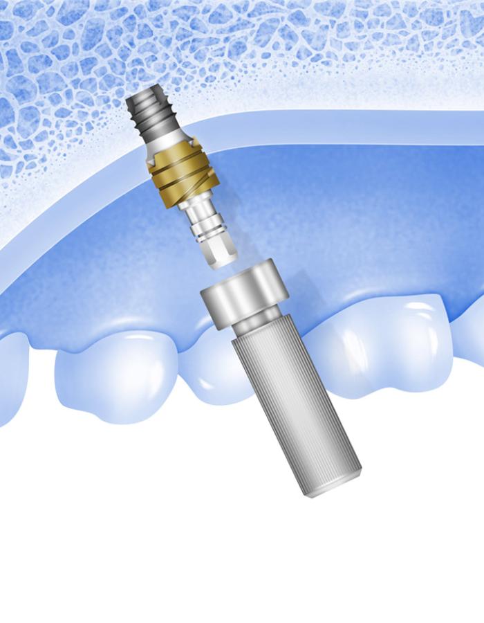 The Palatal Implant + an update on Surgical Wound Closure
